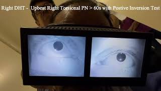 Right Posterior Semicircular Cupulolithiasis with Positive Inversion Test [upl. by Seely]