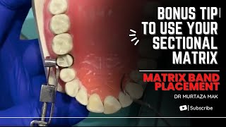 Matrix band placement Bonus tip to use your sectional matrix [upl. by Ibrab]