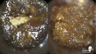 148  Unbelievable Amount of Ear Wax Removal from Crying 7 Year Old Child using the WAXscope®️ [upl. by Marka]