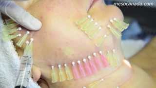 Thread Lifting 4D Mesotherapy [upl. by Ordisy]