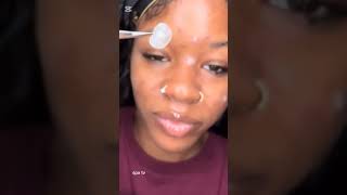 blackheadwhiteheadtreatmentsbotmaggotremovalextractionhumanpimplesremoval pimplepopping [upl. by Ylecic]