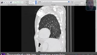 Radiological cases  Chest  CT signs of fissural entrapped pleural effusion [upl. by Adnilreh]