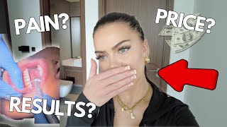 I got veneers in Dubai no teeth shaving before  after VLOG [upl. by Eilla]