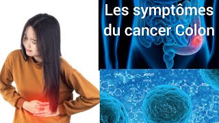 Les symptômes du cancer du colon [upl. by Ongineb]