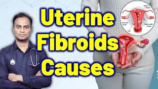 Causes For Uterine Fibroids Treatment Cure Medicine Surgery Gynaecology Women Female  Dr Bharadwaz [upl. by Hosfmann]