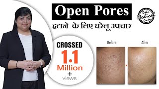 Home Remedies for Open Pores In Hindi  Open Pores Treatment by Dermatologist  Dr Nivedita Dadu [upl. by Derfniw]