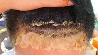 Flaky Dandruff Scratching Scalp Psoriasis 255 [upl. by Anaujit]