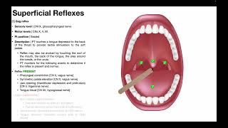 Gag Reflex  Procedure amp Results Interpretation [upl. by Libby]