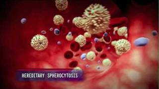 How Hereditary Spherocytosis Causes Anemia [upl. by Musser416]