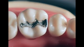 Class II amalgam cavity preparation and restoration [upl. by Aicined]