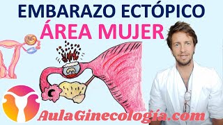 EMBARAZO ECTÓPICO o EXTRAUTERINO QUÉ ES RIESGOS TRATAMIENTO  Ginecología y Obstetricia [upl. by Onirotciv]