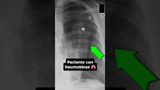 Cuál es el mejor modo ventilatorio para paciente con Neumotórax ⁉️🫁 emergency [upl. by Ultann]