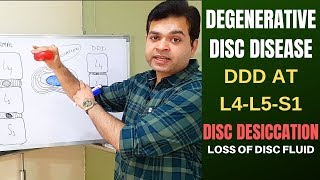 Degenerative Disc Disease DDD L4 L5 L5 S1Disc Desiccation Disc Degeneration Disease Treatment [upl. by Llerej529]