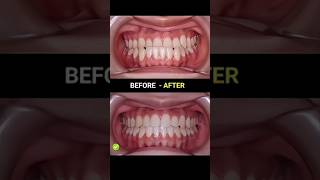 Under bite braces evolution braces orthodontist dentist dentisty cosmeticdentistry [upl. by Noizneb]