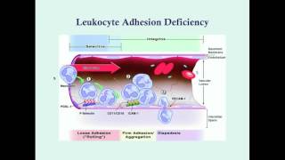 Leukocyte Adhesion Deficiency  CRASH Medical Review Series [upl. by Lida447]