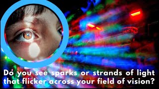 Flashing Lights In Field Of Vision  EXPLAINED  Dr DOrio Eyecare [upl. by Llerod52]