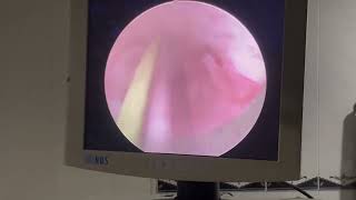 Urethral Stricture treated by DVIU [upl. by Ellenar]