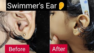 What is Swimmers Ear Ear Pain Treating Swimmers Ear  Treating Swimmers Ear rid of swimmer’s ear [upl. by Engedus]