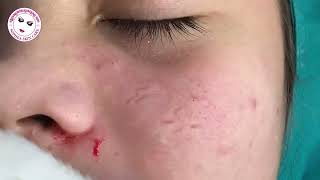 Acne facial removal treatment by Sopheaskincarecambodia 04 April 2023 [upl. by Nybor387]