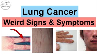 Lung Cancer Weird Signs and Symptoms  Paraneoplastic Syndromes of Lung Cancer [upl. by Nalro]