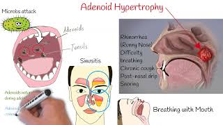 Adenoid Hypertrophy  If your kid sleeps with open mouth you should watch this video [upl. by Rucker388]