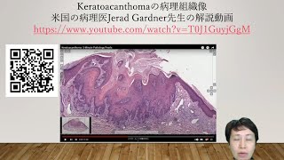 keratoacanthomaの病理組織像 [upl. by Selassie387]