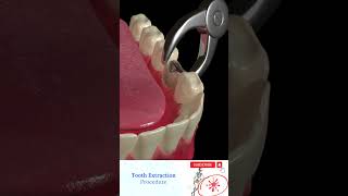 Tooth Extraction Animation  Aftercare View [upl. by Koressa]