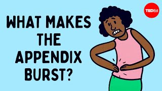 What does appendix pain feel like  David R Flum [upl. by Saree]