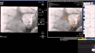 YStentAssisted Coil Embolization of Middle Cerebral Artery Aneurysm  Demetrius Lopes MD [upl. by Ardnuek]