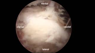 Endoscopic decompression for lumbar stenosis by UBE [upl. by Ifill]