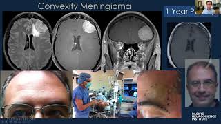 Keyhole Meningioma Removal with Dr Daniel Kelly [upl. by Gauthier478]