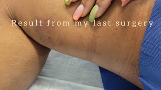 My vein checkup and another surgery [upl. by Hallette924]