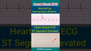 ECG changes During Heart Attack medicine ecg [upl. by Otsirave]