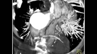 Cardiac Coronary Artery Bypass Graft Evaluation 1 of 5 [upl. by Joyce759]