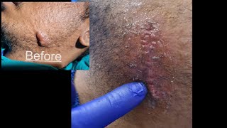 Keloid First Laser maintenance Session for avoiding recurrence For enquiry call 9700020802 [upl. by Ellehcear10]