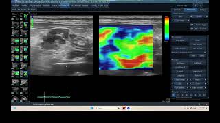 IQ 304 MESENTARY LYMPHOID NODE ENLARGEMENT ULTRASOUND ECHOPAC ANALYSIS ELASTOGRAPHY pancreatitis [upl. by Aldrich]