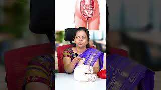 What is Breech Delivery  Dr Shilpa G B Gynecologist [upl. by Keli]