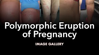 Polymorphic Eruption of Pregnancy Image Gallery [upl. by Imogene545]