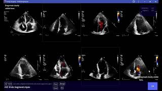 Ranking A4C echo images based on the visibility of the Endocardial Segments [upl. by Enirehtac]