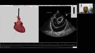 Simulation in Cardio Thoracic Anaesthesia and Transoesophageal Echocardiography by Dr Muralidhar K [upl. by Mapel]