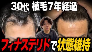 【植毛結果】7年経っても変わらない驚きの成功例！20代前半で薄毛に悩んで後悔した事 [upl. by Breen243]