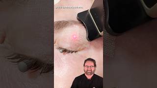 Eyelid CO2 Laser Treatment Surgeon Reacts [upl. by Gower534]