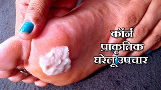 कॉर्न के उपचार  Corn Treatment in Hindi  corn ka ilaj  corn treatment at home [upl. by Fital]