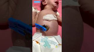 Umbilical Cord Caremedical viralvideo [upl. by Nino22]