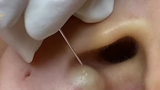 relaxing blackheads removal pimple popping videos blackheads removal large blackheads popping relax [upl. by Kane]