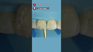 Restoring Patients Confidence dental toothfilling dentist toothrestoration dentistry [upl. by Ecam]