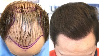 FUE Hair Transplant REPAIR 3000 Grafts Norwood V By Dr Juan Couto  FUEXPERT CLINIC Madrid Spain [upl. by Drofliw]