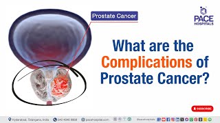 Complications of Prostate Cancer  What are the Complications of Prostate Cancer  prostatecancer [upl. by Kcirddec]