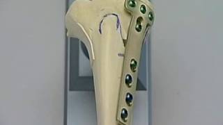 High Tibia Valgisation Osteotomy HTO Open wedge With The Tomofix System [upl. by Irrac700]