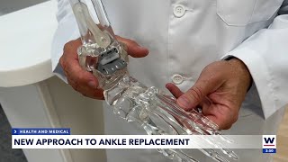 3D technology helps ankle replacement surgery [upl. by Belac]